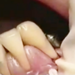 Mucogingival Surgery