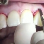Immediate One Stage Implant Placement